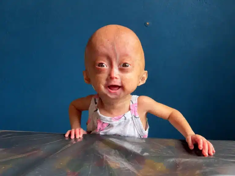 Elis, uma das gêmeas de Roraima com progéria, morre aos cinco anos